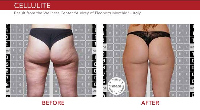 ICOONE Result